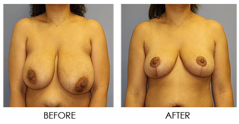 Breast Reduction Chicago