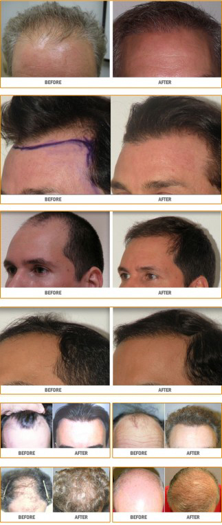 Hair Transplant - Before and After